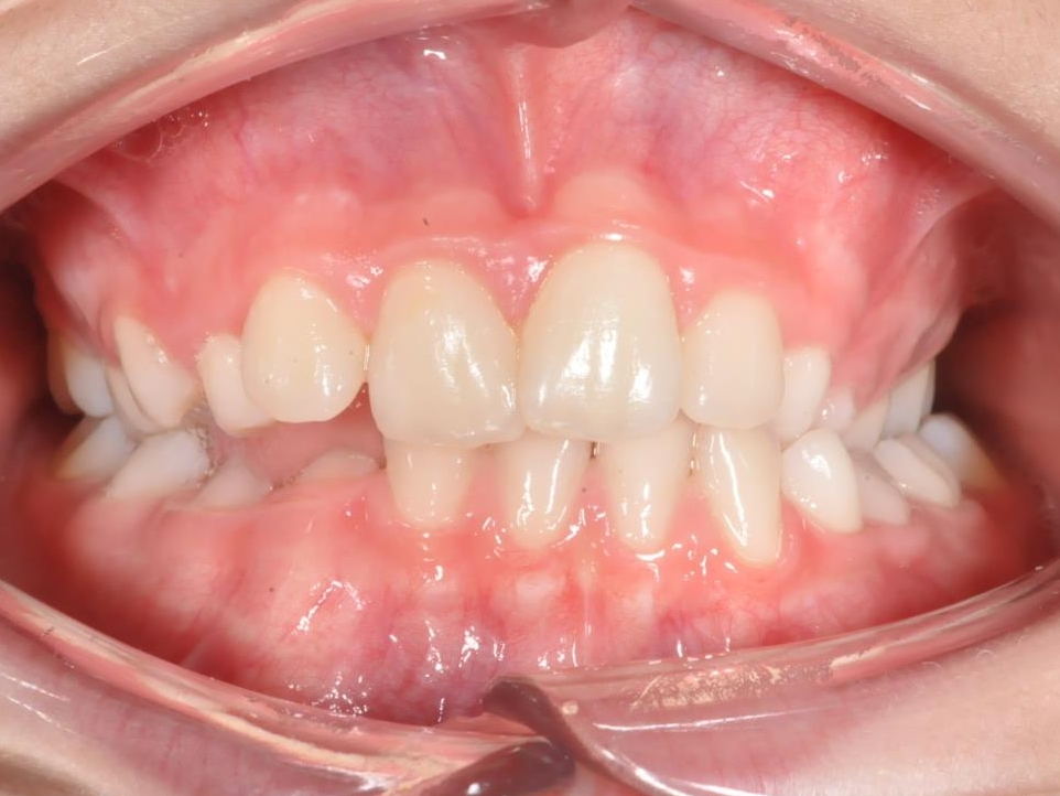 20-06-2019 Intra-orale Face Avant traitement 1