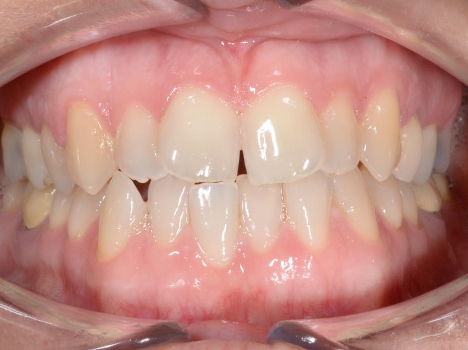 08-12-2015 Intra-orale Face Avant traitement 1