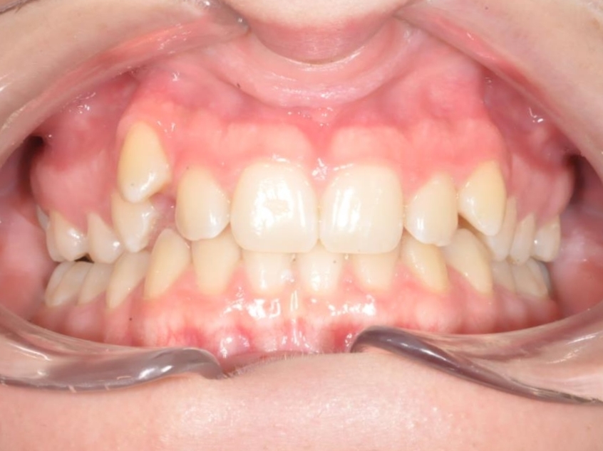 30-08-2019 Intra-orale Face Avant traitement 1