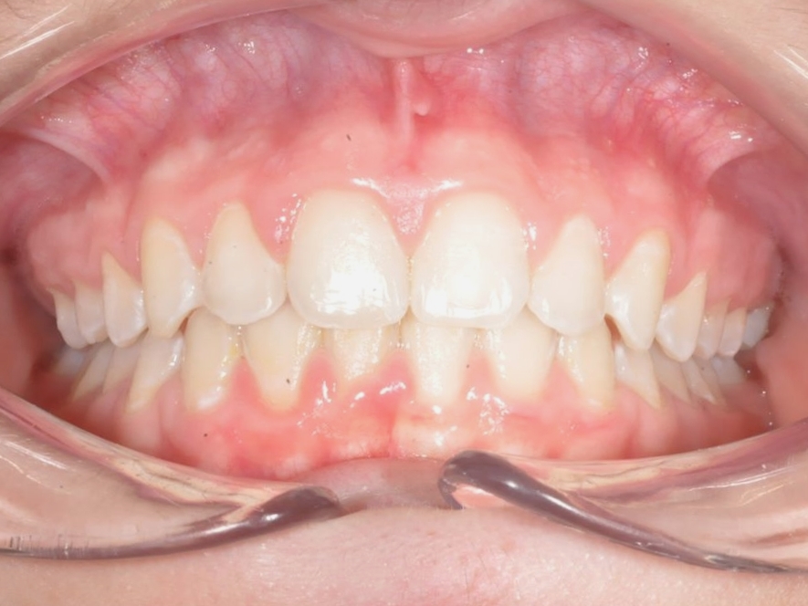 27-10-2021 Intra-orale Face Après traitement 1
