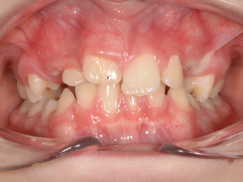 22-04-2015 Intra-orale Face Avant traitement 1
