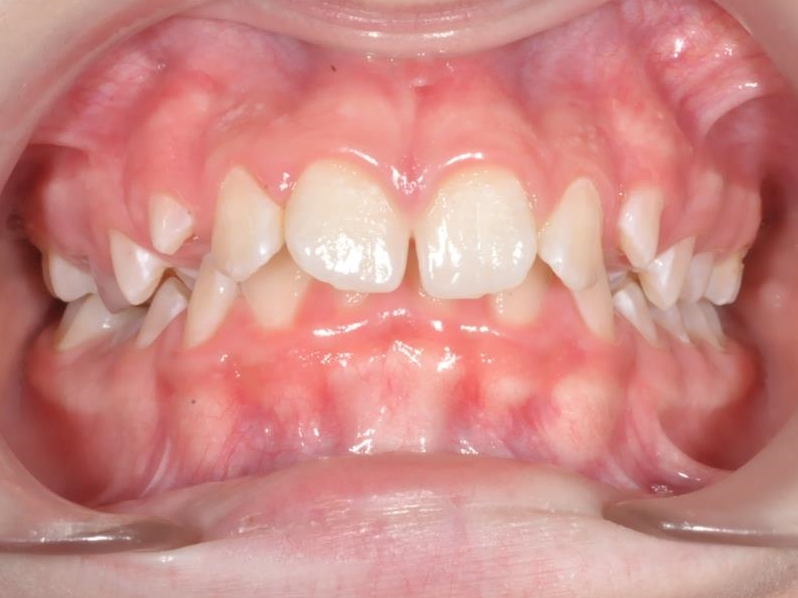 14-01-2019 Intra-orale Face Avant traitement 1